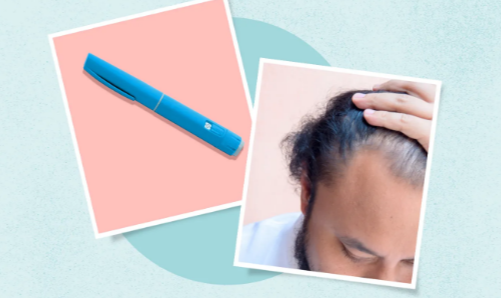 Does GLP 1 Cause Hair Loss: Common Questions, Risks, and Better Comparison Criteria